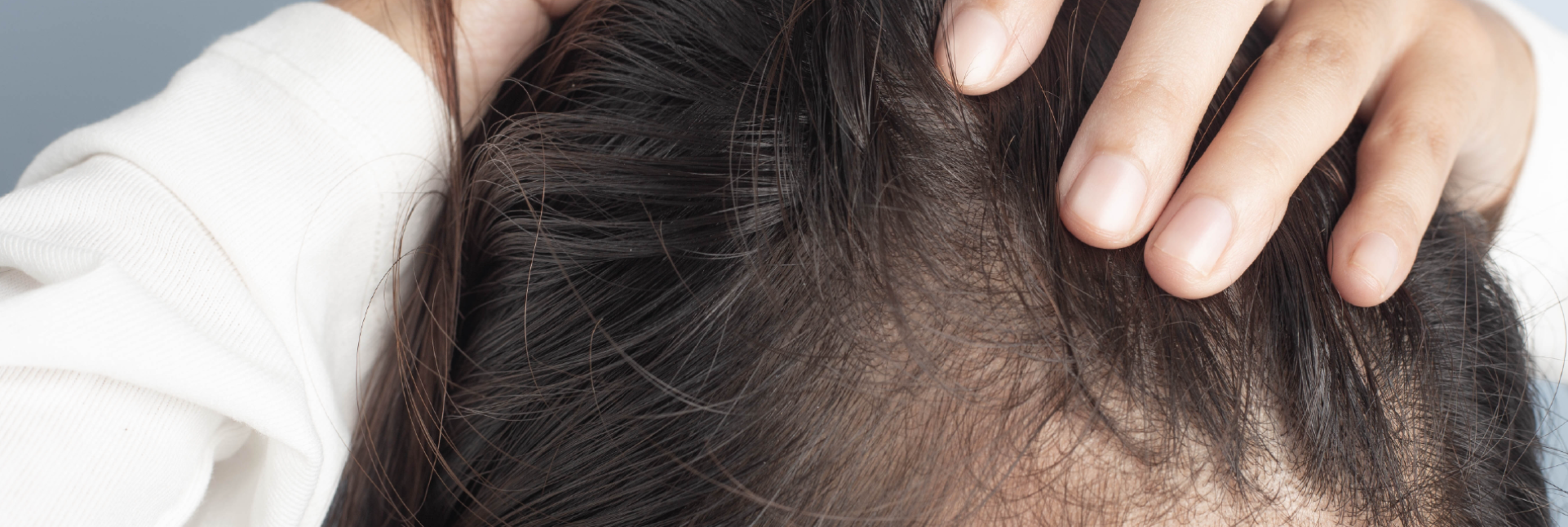 Alopecia frontal fibrosante: síntomas, causas y tratamiento